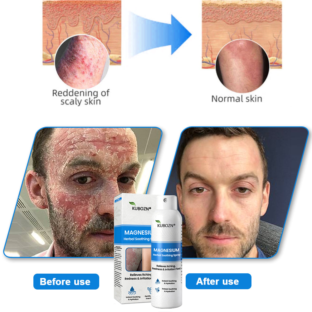 ✅  Official Store:KUBOZN® Magnesium Herbal Spray – Fast Relief for Psoriasis & Eczema | No-Rub, Steroid-Free