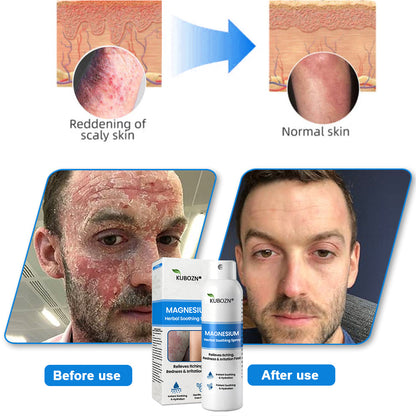✅  Official Store:KUBOZN® Magnesium Herbal Spray – Fast Relief for Psoriasis & Eczema | No-Rub, Steroid-Free
