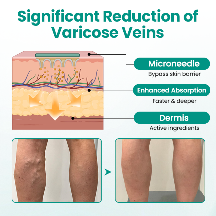 KUBOZN® LegRenew Varicose Veins Patch