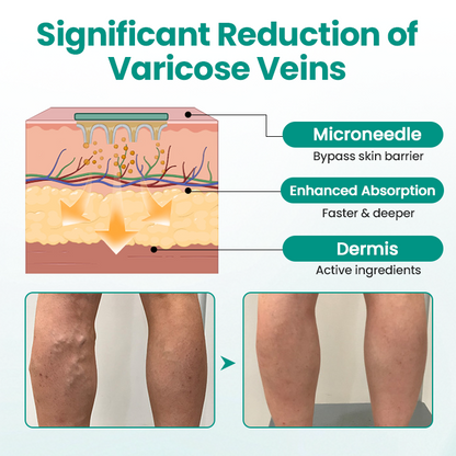 KUBOZN® LegRenew Varicose Veins Patch