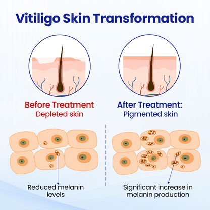 Cvreoz® Vitiligo Treatment Spray 🌿 Herbal Formula Certified — (Supports Repigmentation, Prevents New Spots, and Restores Natural Skin Tone Without Steroids) (offer)