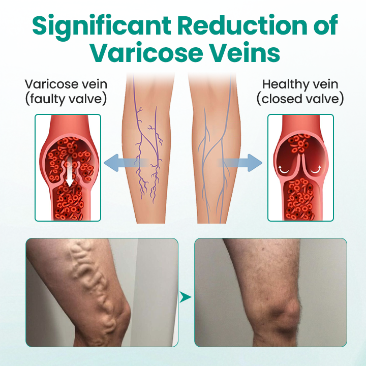KUBOZN® LegRenew Varicose Veins Patch